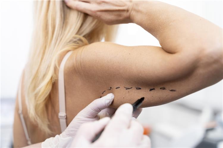 Liposuction Liposuction
